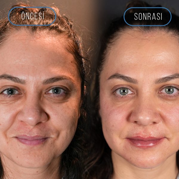 TAM YÜZ POST TAM YÜZ POST