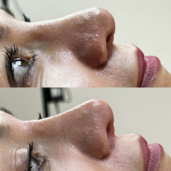 anasayfa-burun anasayfa-burun