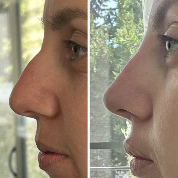 burun-dolgusu-ankara-9 burun-dolgusu-ankara-9