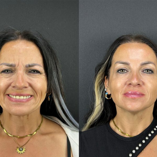 yuz-botoks-uygulamasi-ankara yuz-botoks-uygulamasi-ankara